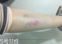 摔傷了涂什么藥好的快？做好消毒才能愈合快