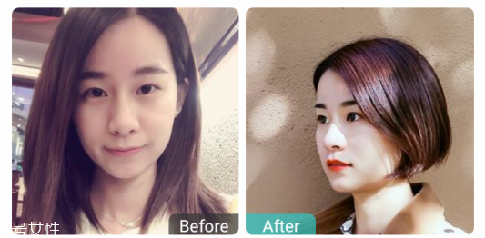 下瞼整形多久能恢復(fù)自然？半年時間