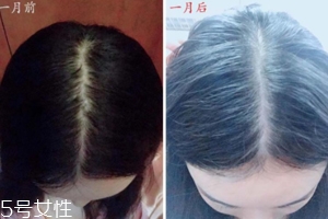 柳屋生發(fā)水有用嗎？一個月后長出新發(fā)