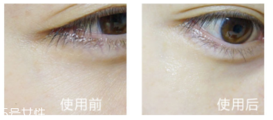 shangpree香蒲麗眼膜適合多大年齡？任何年齡