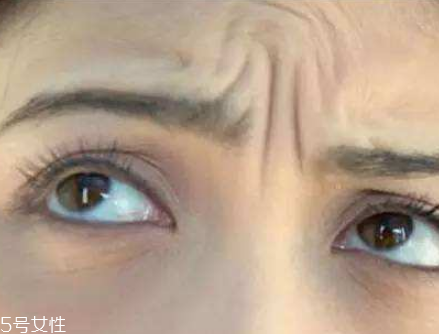 川字紋可以手術(shù)去除嗎？選擇手術(shù)需謹(jǐn)慎