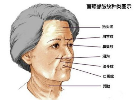 川字紋可以打玻尿酸嗎？不是最佳選擇