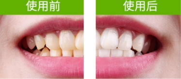 牙貼怎么分上下牙貼？牙貼怎么分正反
