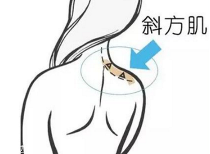 瘦肩針間隔多久打一次？打瘦肩針間隔時(shí)間