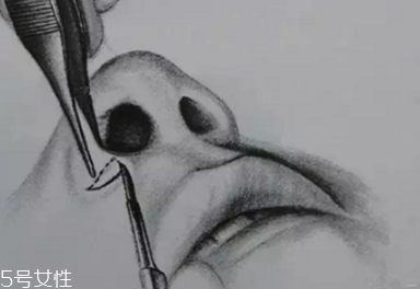 鼻翼外切多久消腫？鼻翼外切消腫時間要多長？