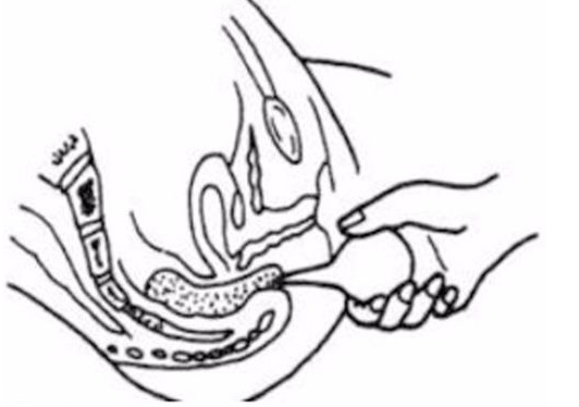 開塞露躺著還是蹲著用？開塞露使用姿勢