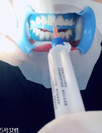 冷光美白會反彈嗎？冷光美白心得