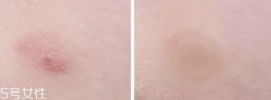 vt痘痘貼怎么用？vt老虎痘痘貼防水嗎