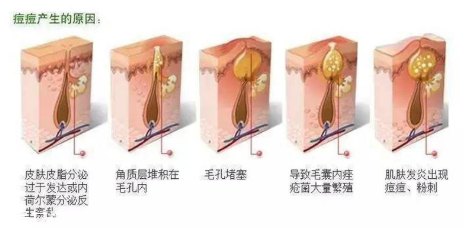 頑固痘痘怎么消除？油皮為什么反復(fù)爆痘？