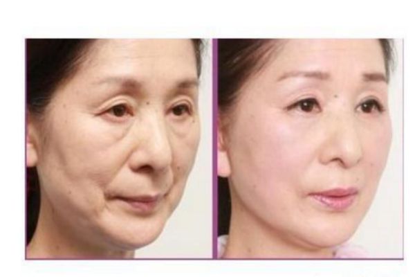 除皺針打完笑容僵硬多久能恢復(fù) 除皺針打完后有什么反應(yīng)