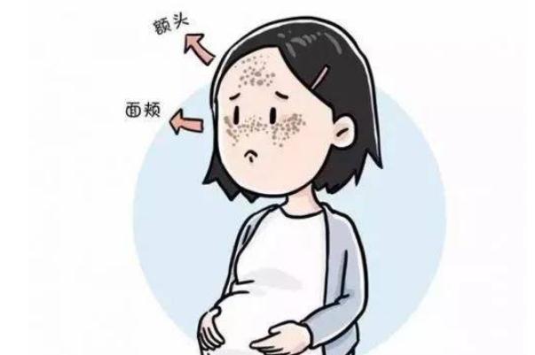 妊娠斑會自動(dòng)消除嗎 妊娠斑會遺傳嗎