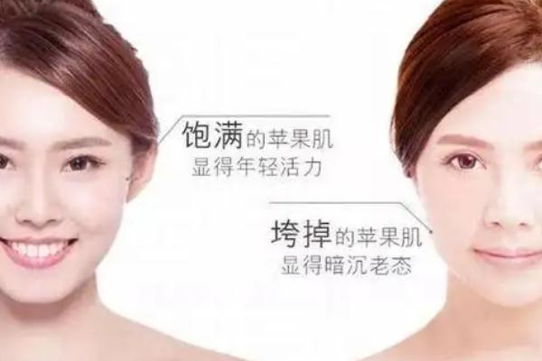 蘋果肌復位術(shù)怎么做 蘋果肌復位術(shù)可以保持多久