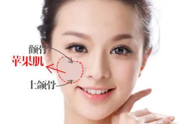 蘋果肌復位術(shù)怎么做 蘋果肌復位術(shù)可以保持多久